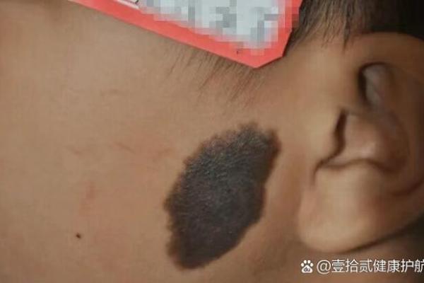 面部胎记算命