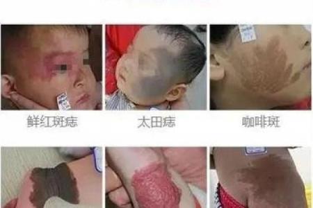 脸的各部位胎记算命详解