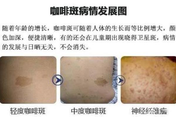 看脸上胎记算命知命运