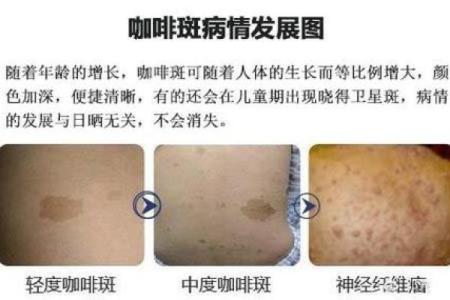 看脸上胎记算命知命运