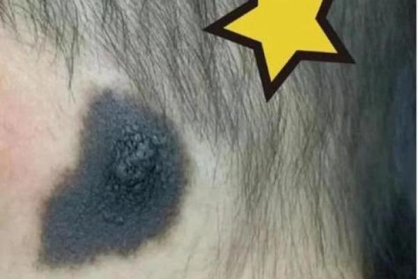 胎记算命：怎么看胎记