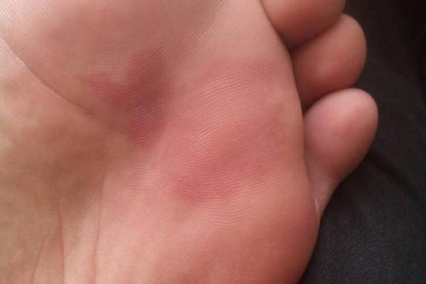 腿部不同位置的胎记算命分析-