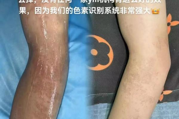 胳膊胎记可以算命吗- 胳膊胎记可以算命吗-