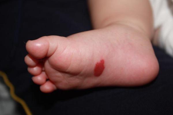 脚底的胎记算命分析 脚底的胎记算命分析