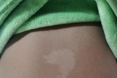 白色胎记算命分析