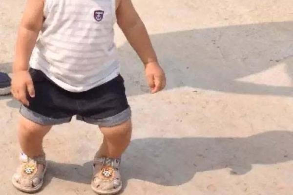 婴儿八字腿 婴儿八字腿