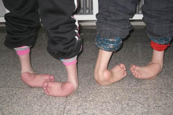 内八字脚鞋 内八字脚鞋