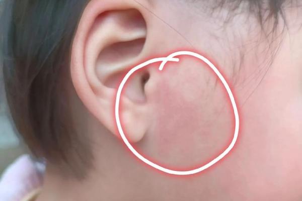 耳朵上的胎记算命分析 耳朵上的胎记算命分析