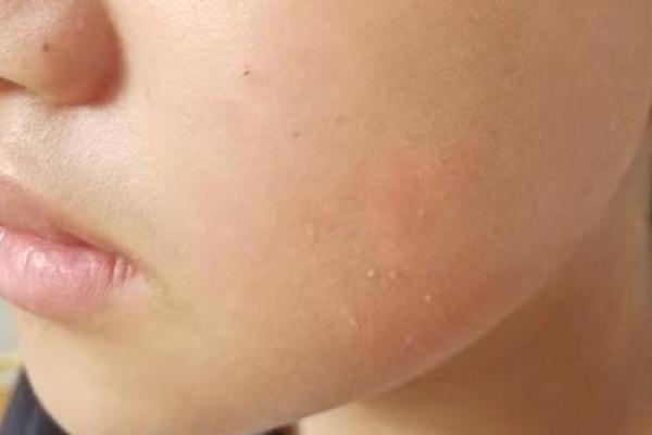 面部不同位置的胎记算命 面部不同位置的胎记算命