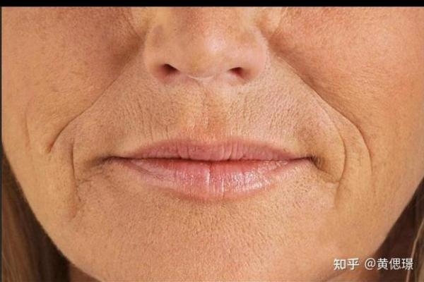 嘴巴八字纹 嘴巴八字纹