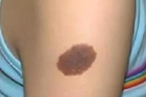 胎记算命胎记的位置与命运