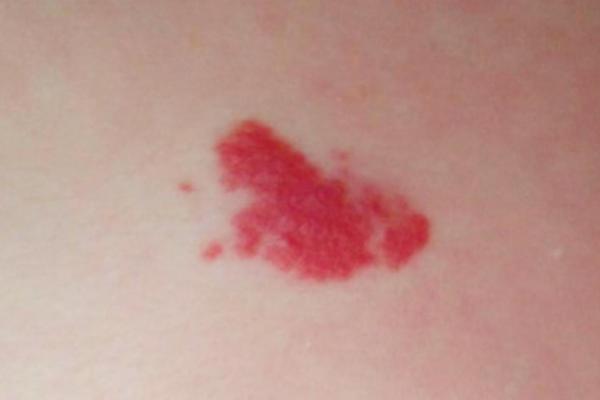 胎记算命图解:什么是红胎记? 胎记算命图解:什么是红胎记?