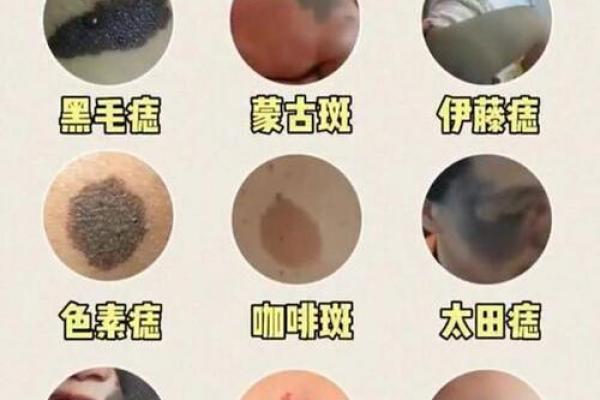 胎记算命图解:什么是红胎记? 胎记算命图解:什么是红胎记?