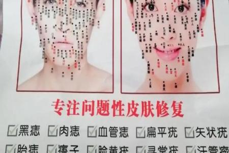祛痣要算命吗