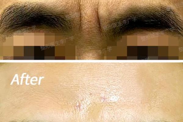 印堂八字纹,男人眉间有八字纹好不好